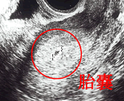 初期 エコー 写真 妊娠