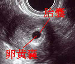 週 胎嚢 大き さ 5 妊娠5週目 胎嚢の大きさ・エコー写真、つわり症状や流産のこと